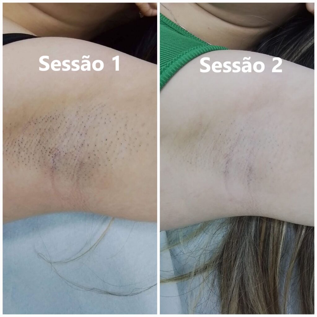 antes-e-depois-axilas---2-sessaes-dWxMM2Wr95C49DGJ